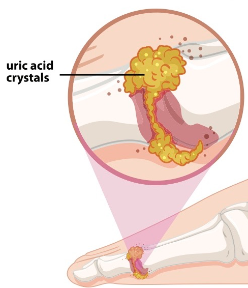 How to prevent Uric Acid